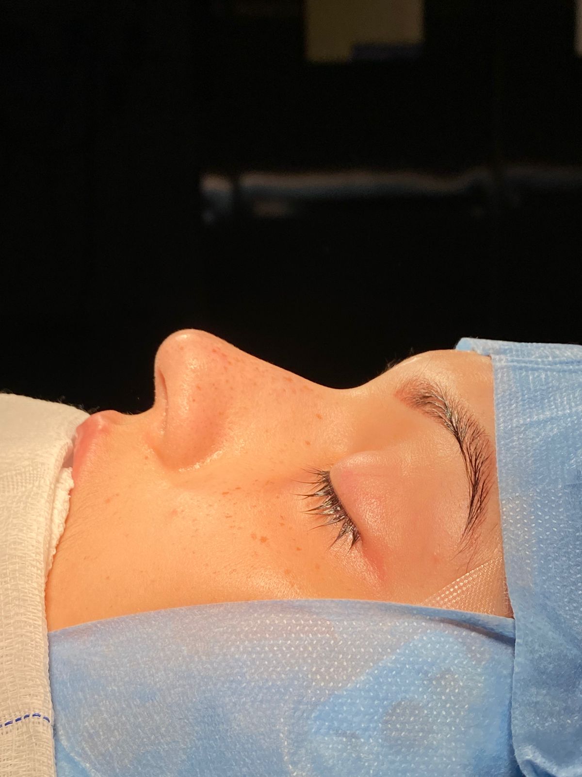 antes rinoplastia