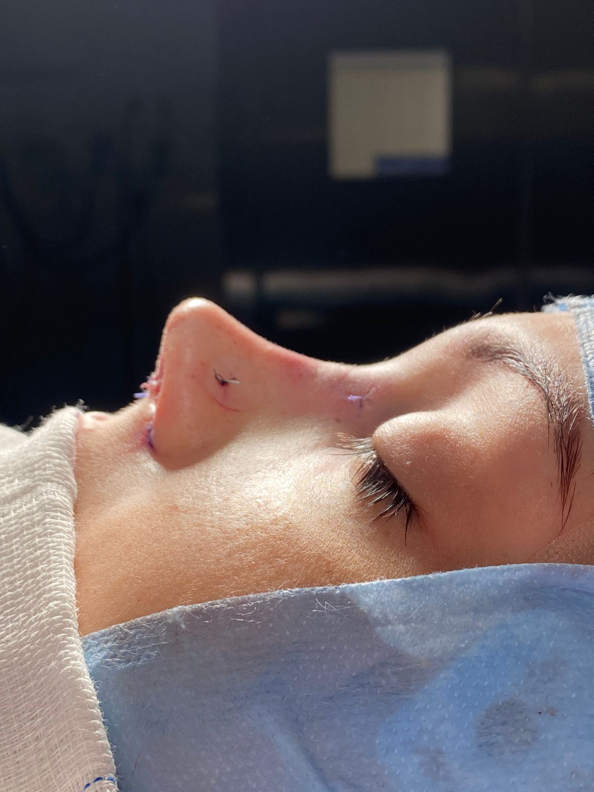 depois rinoplastia