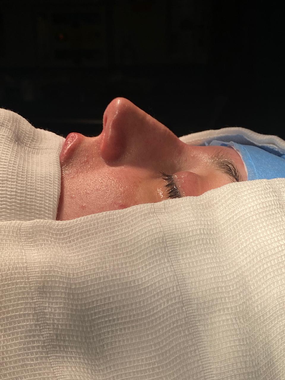 Dra. Julía Gàspar - Rinoplastia Antes e Depois