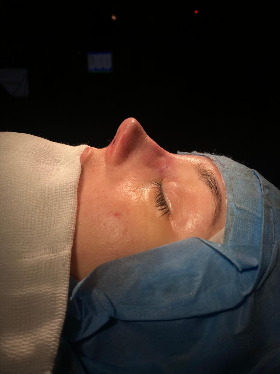 Dra. Julía Gàspar - Rinoplastia Antes e Depois