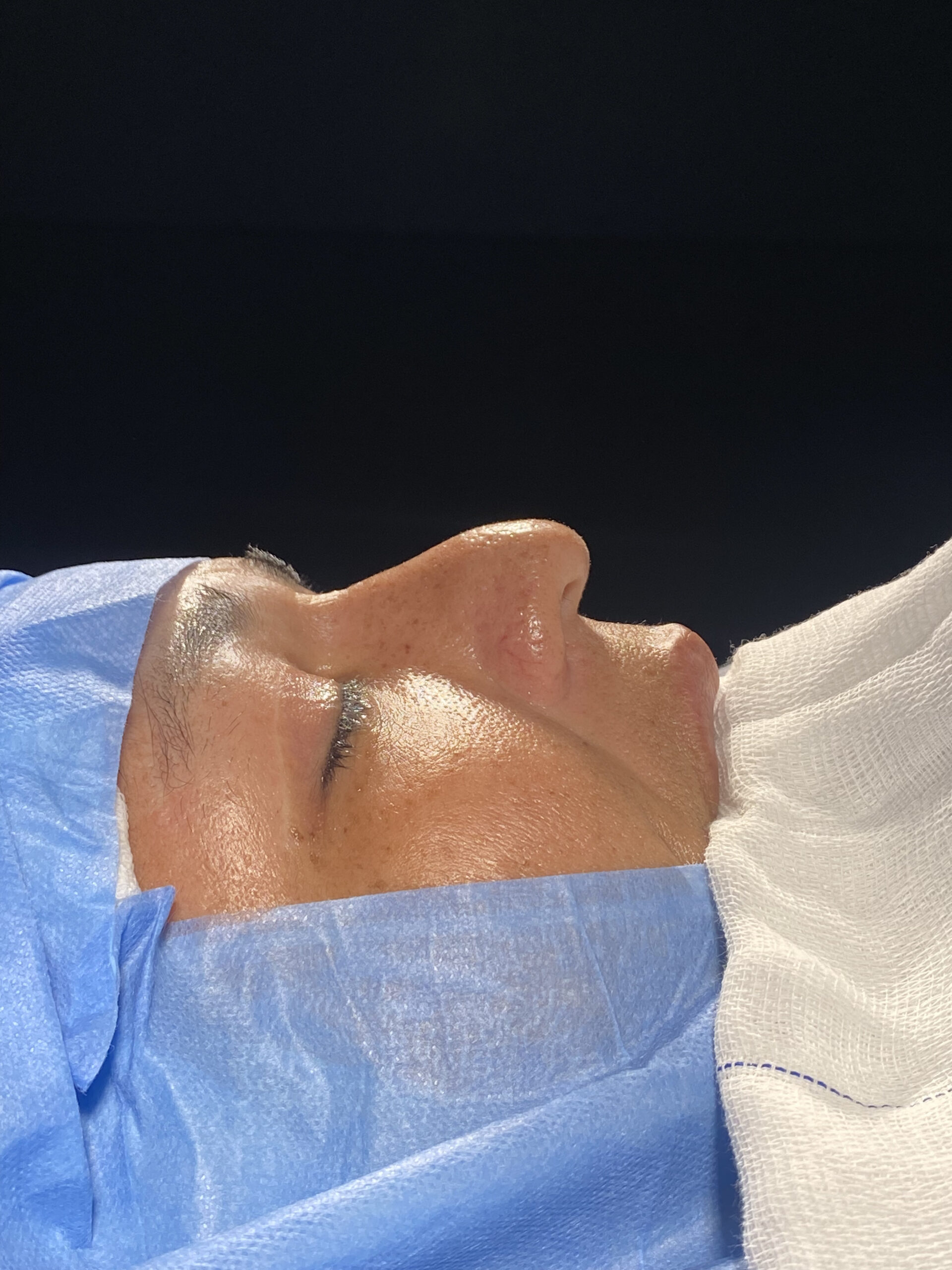 Dra. Julía Gàspar - Rinoplastia Antes e Depois