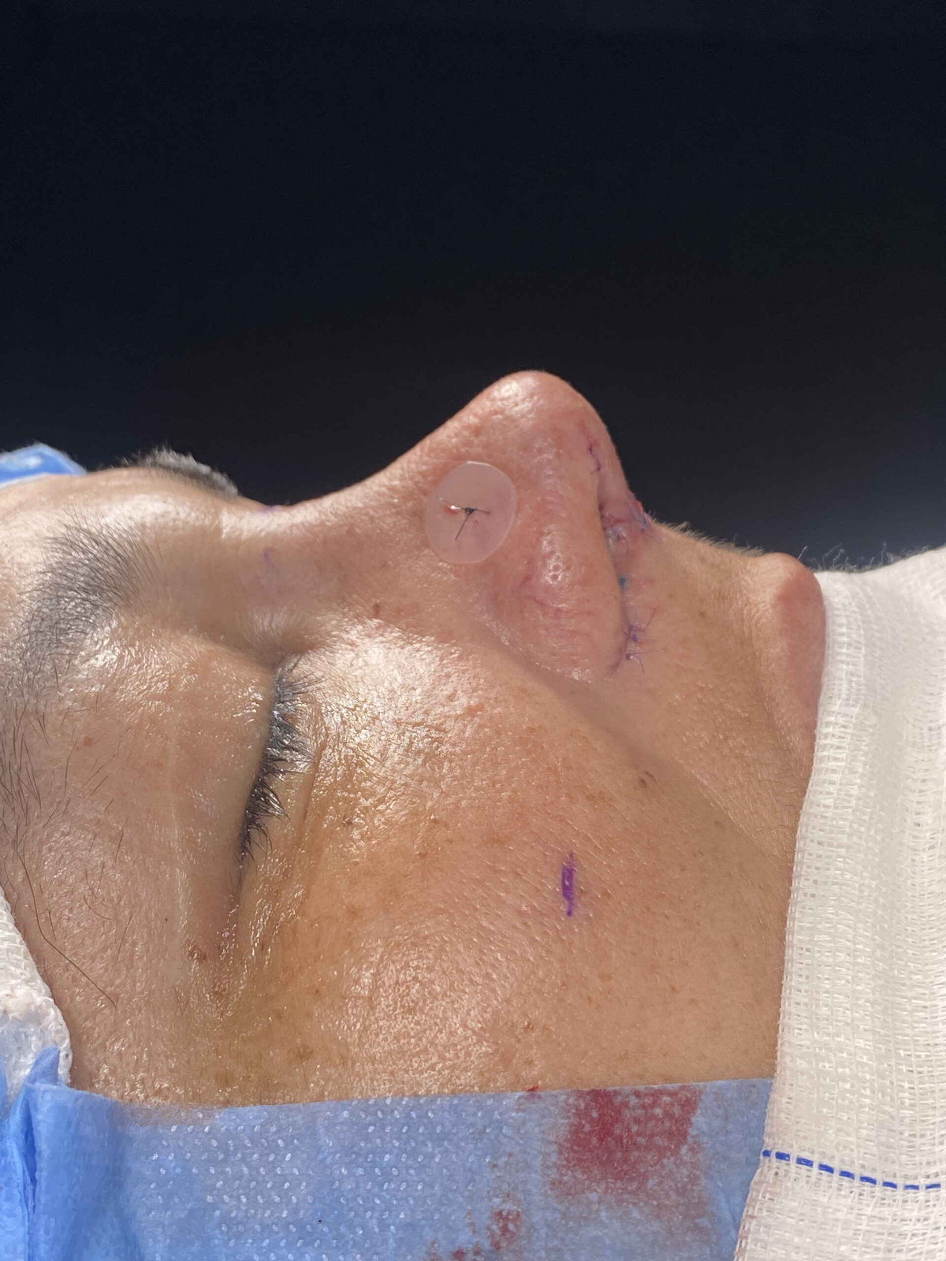 Dra. Julía Gàspar - Rinoplastia Antes e Depois